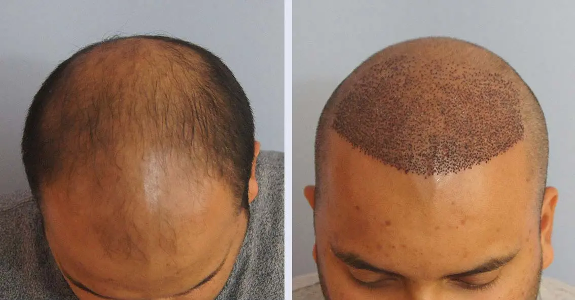 نمونهای از مراحل کاشت مو با روش FUE