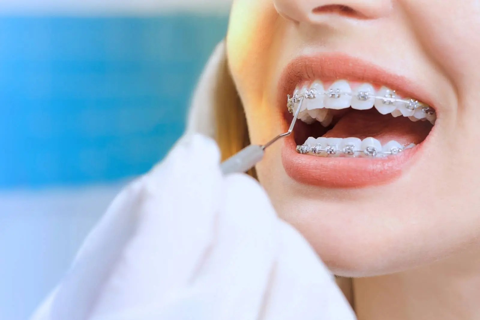 نصب بریس روی دندانها توسط متخصص ارتودنسی