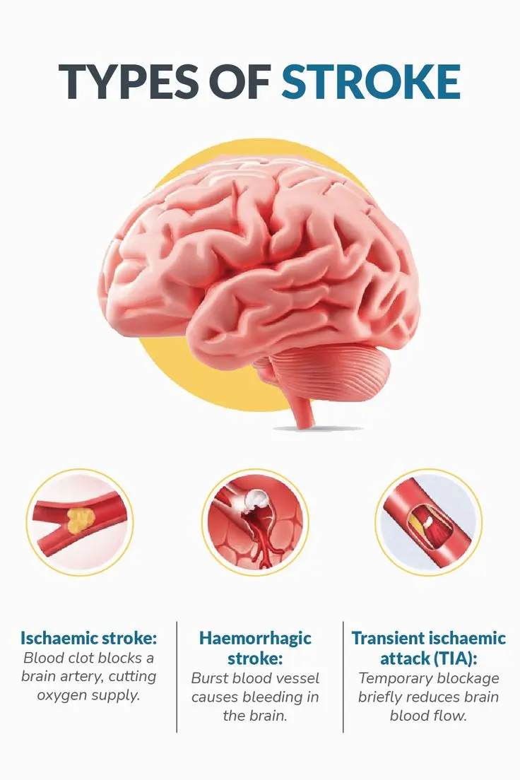 علائم اولیه سکته مغزی در یک فرد مبتلا به ضعف یک طرفه و مشکل در گفتار