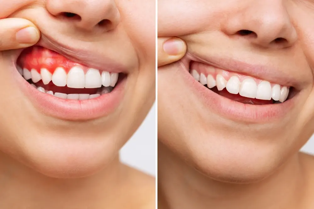 نمونهای از روش پاکسازی لثه توسط دندانپزشک