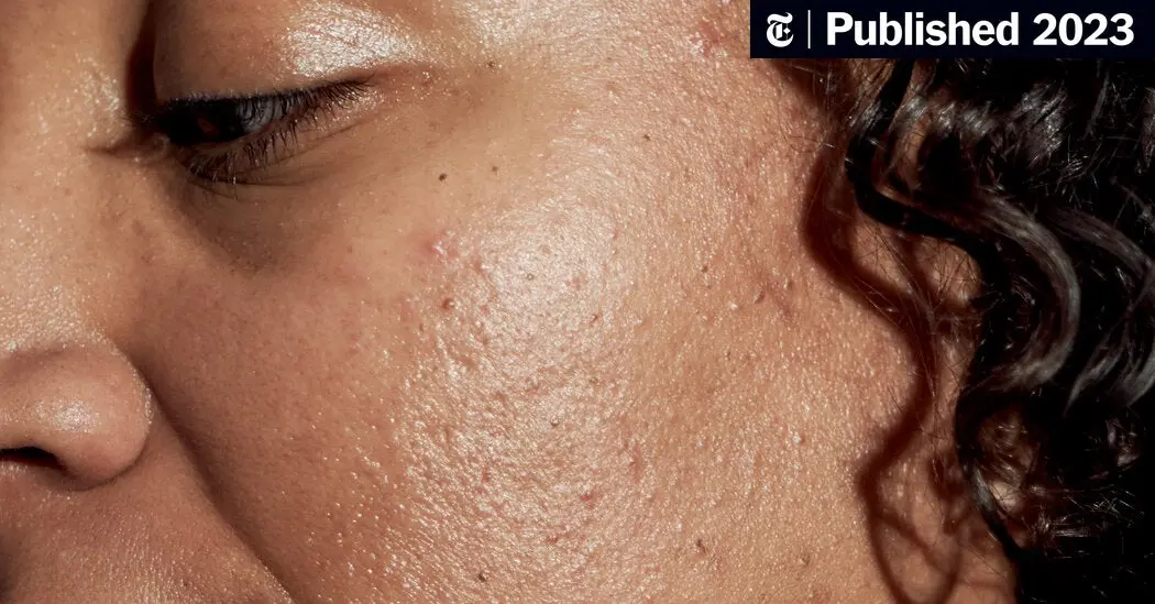 جوش صورت چرا ایجاد می‌شود؛ پاسخ به پرسش‌های مهم