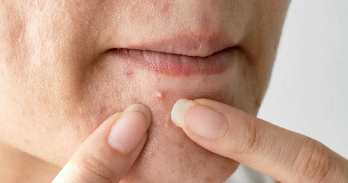 جوشهای سیاه رنگ در نواحی چرب پوست مانند پیشانی و بینی