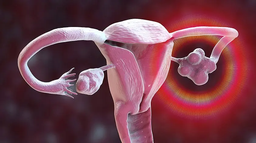 زنی که با پزشک در مورد علائم PCOS صحبت میکند، نشاندهنده اهمیت مراجعه به متخصص برای تشخیص و درمان