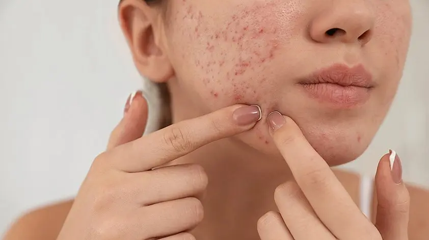 جوش سرسفید چیست و چه تفاوتی با جوش سرسیاه دارد؛ نکات مهم و کاربردی