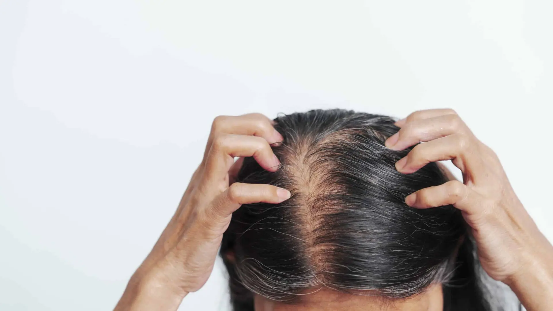 نمونه‌ای از ریزش مو در زنان