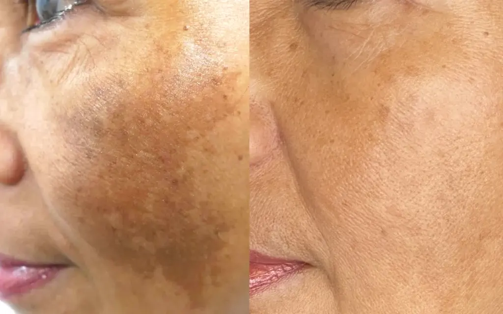 پوستی سالم و یکنواخت بدون لکههای تیره