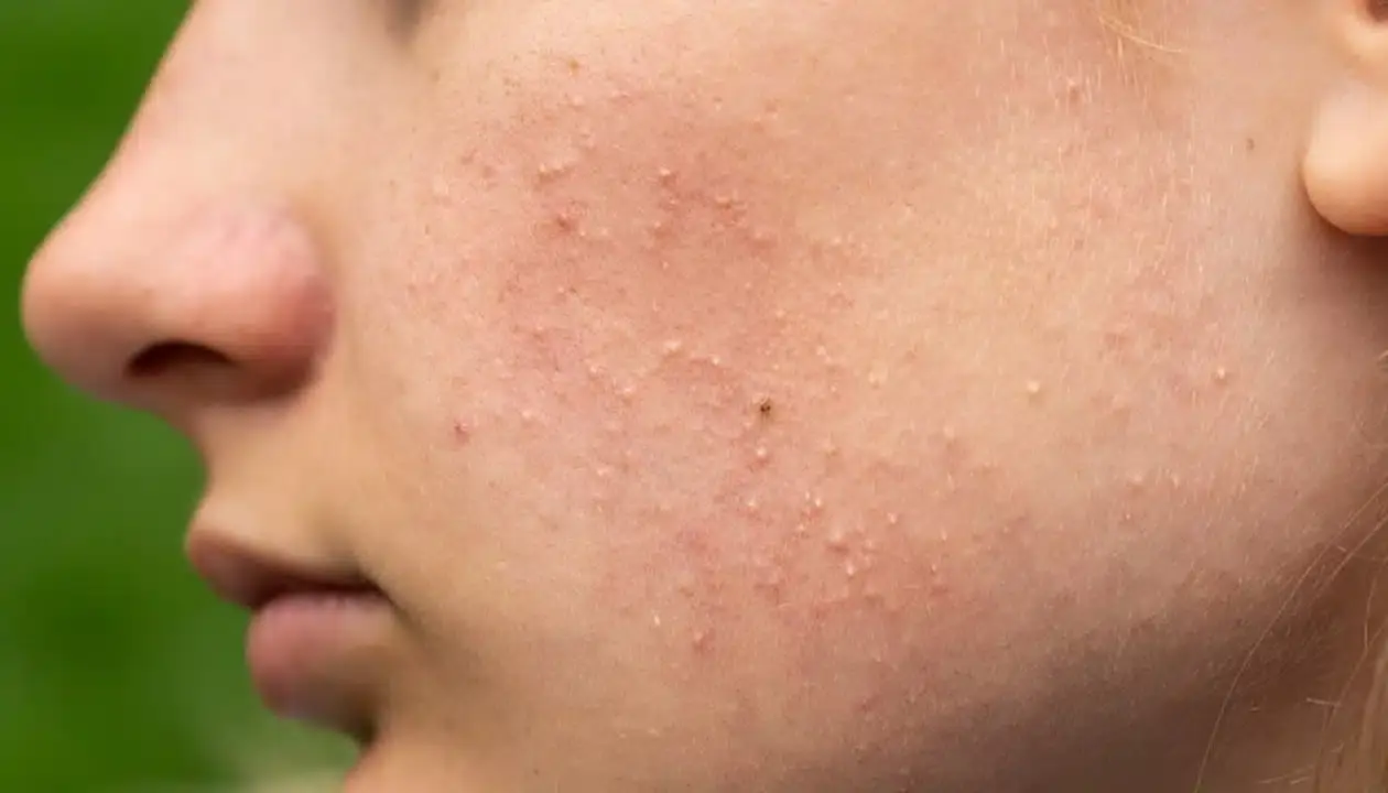 نمونههای مختلف جوش صورت از جمله جوش سفید، سیاه و قرمز