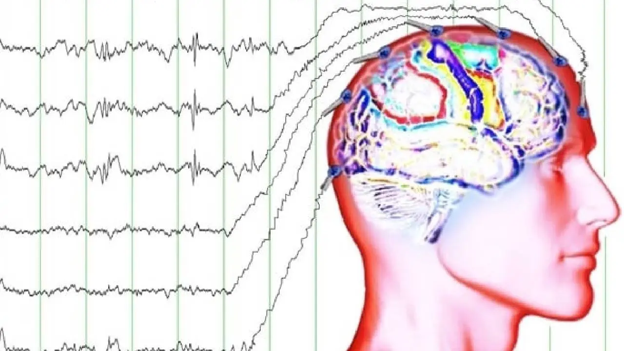 الکترودهای EEG روی سر یک بیمار برای اندازه‌گیری فعالیت الکتریکی مغز
