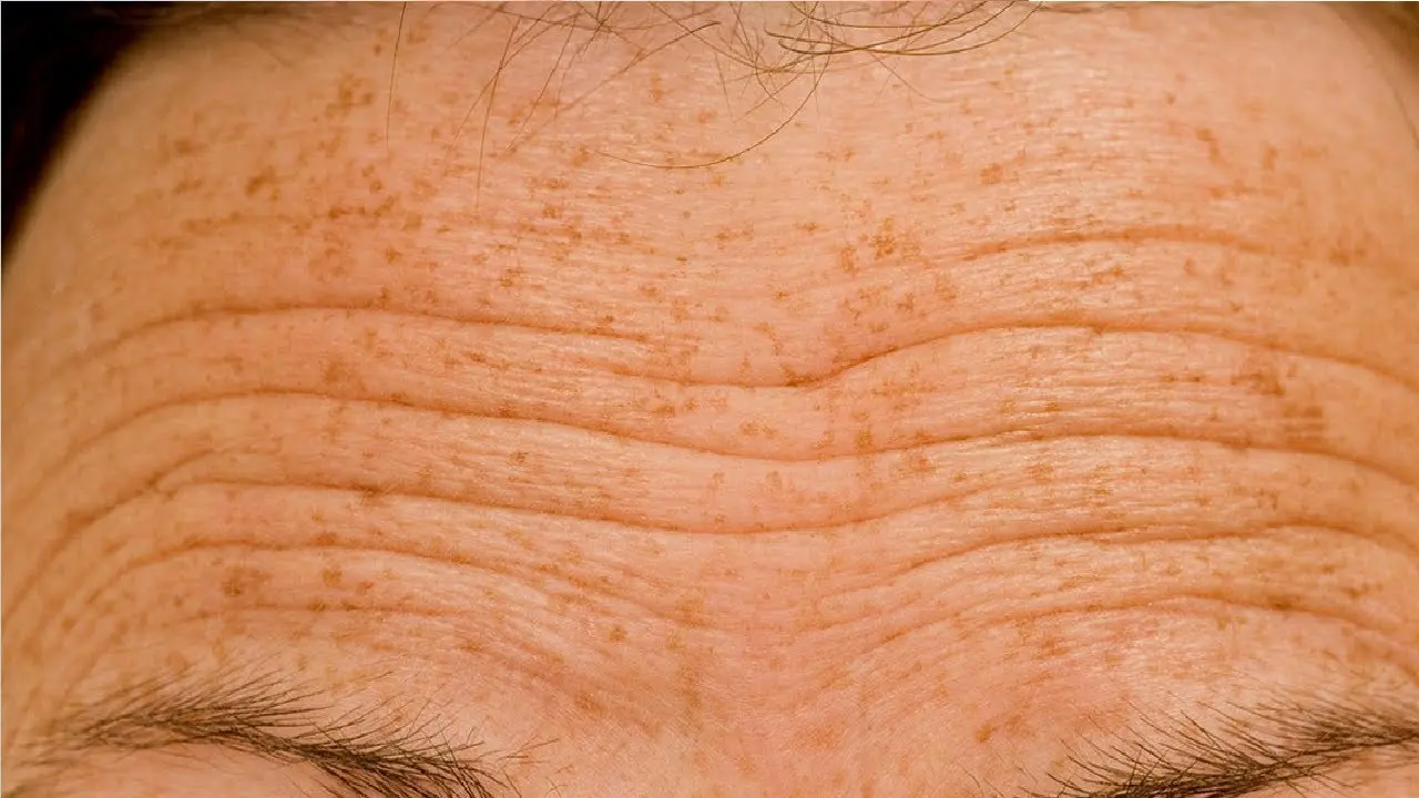 چین‌وچروک پوست از چه سنی شروع می‌شود؛ راهنمای ساده برای شروع