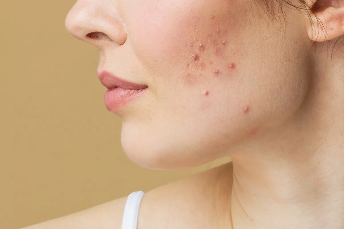 نمونه‌ای از لک‌های پوستی روی صورت