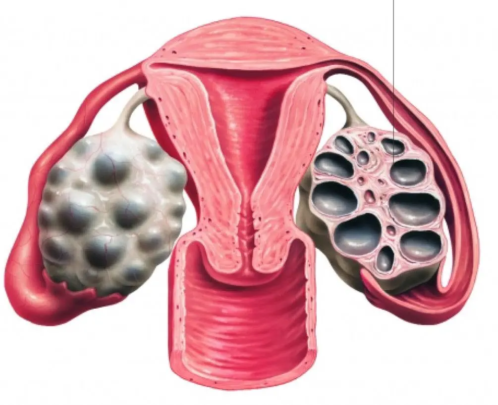 PCOS چیست و چه علائمی دارد؛ راهنمای ساده برای شروع