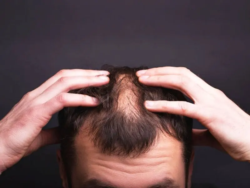 ریزش مو بعد از استرس چرا اتفاق می‌افتد؛ بررسی نکات و جزئیات مهم