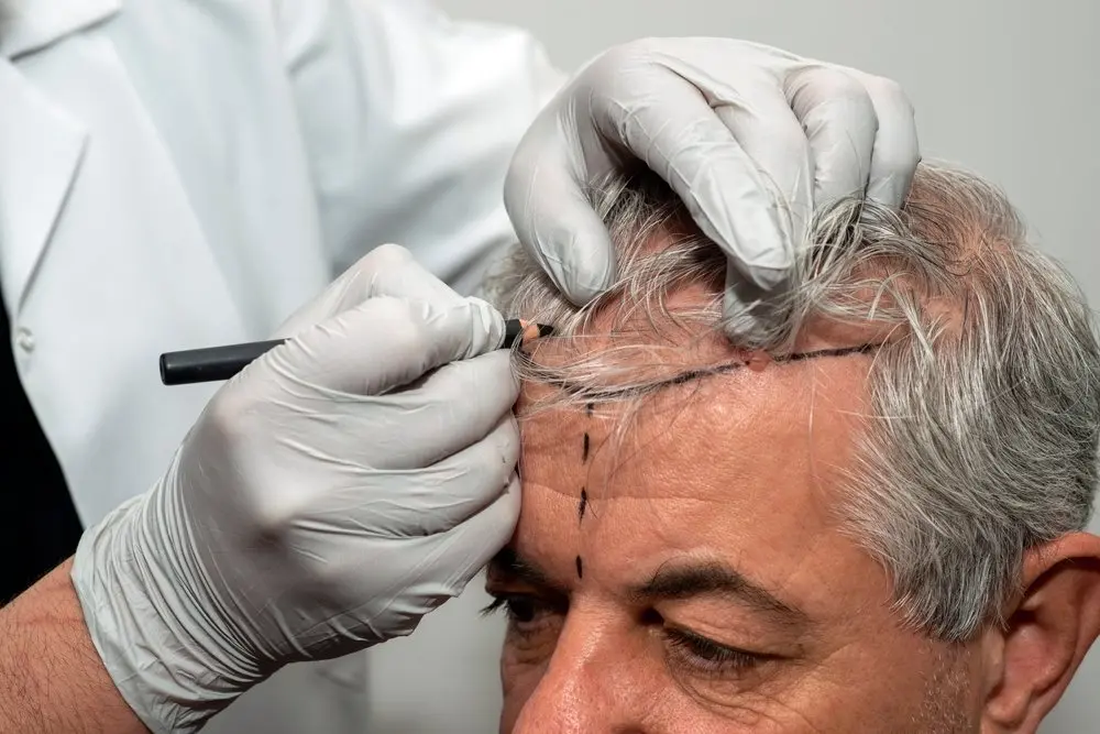 مشاهده نتایج طبیعی پس از کاشت مو با روشهای پیشرفته