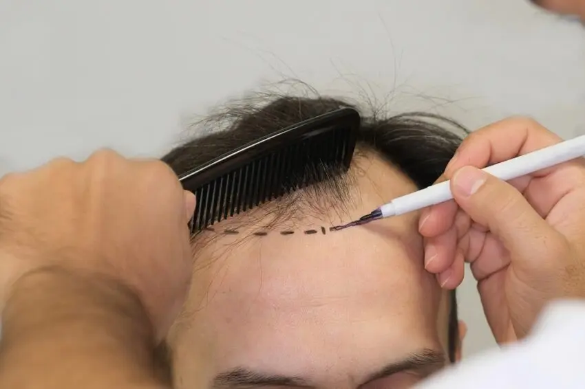 نمونهای از روشهای کاشت مو با استفاده از تکنیکهای مختلف